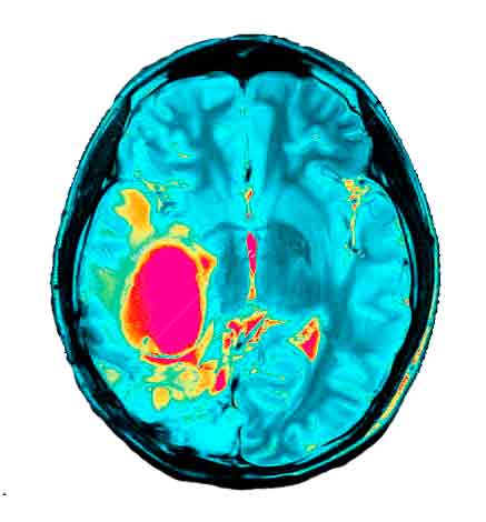 Радиохирургия головного мозга