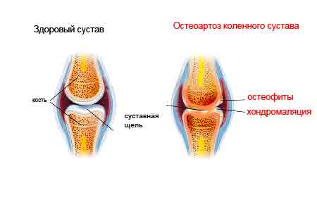 Артроз коленного сустава (фото)