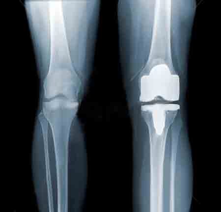 Эндопротезированный коленный сустав фото