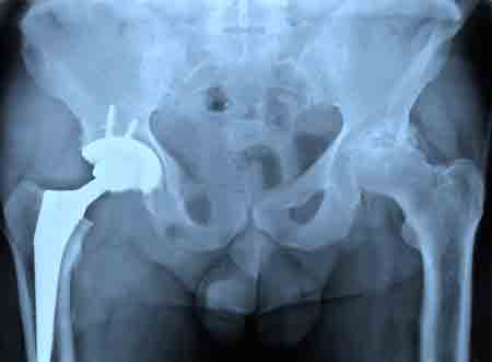 Рентген эндопротезированного тазобедренного сустава